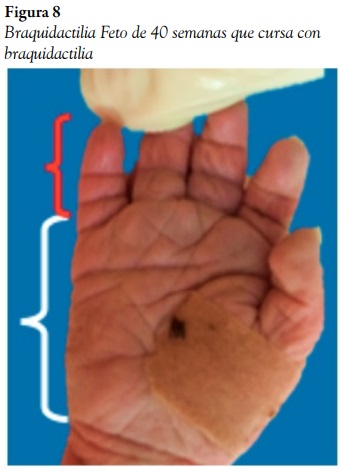 Braquidactilia Feto de 40 semanas que cursa con braquidactilia