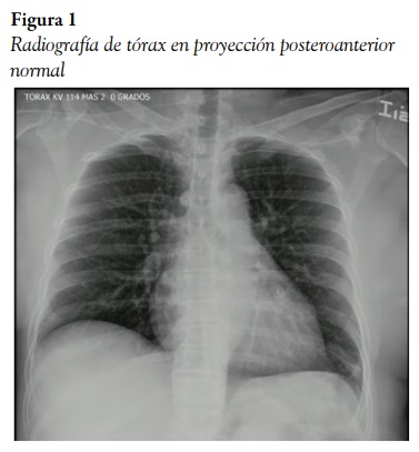 Radiograf&iacute;a de t&oacute;rax en proyecci&oacute;n posteroanterior normal