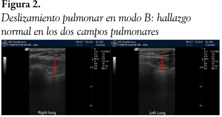 Deslizamiento pulmonar en modo B: hallazgo normal en los dos campos pulmonares