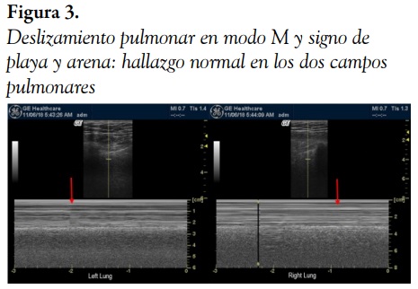 Deslizamiento pulmonar en modo M y signo de playa y arena: hallazgo normal en los dos campos pulmonares