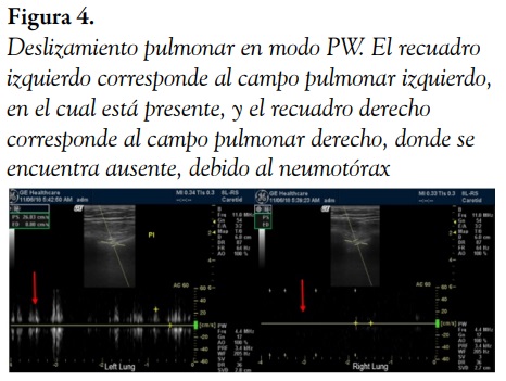 Deslizamiento pulmonar en modo PW. El recuadro izquierdo corresponde al campo pulmonar izquierdo, en el cual est&aacute; presente, y el recuadro derecho corresponde al campo pulmonar derecho, donde se encuentra ausente, debido al neumot&oacute;rax