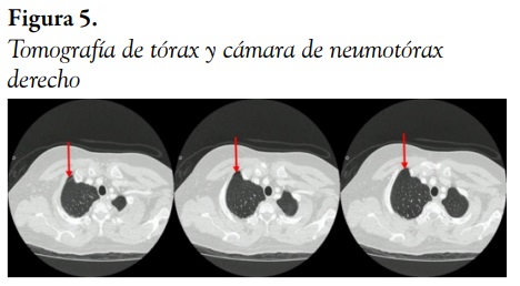 Tomograf&iacute;a de t&oacute;rax y c&aacute;mara de neumot&oacute;rax derecho