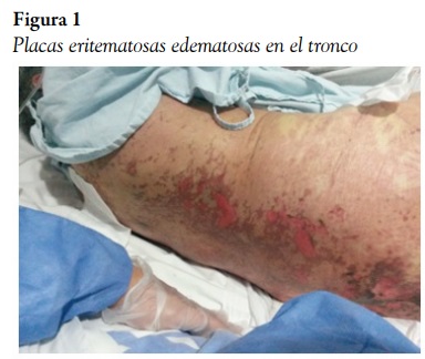 Placas eritematosas edematosas en el tronco