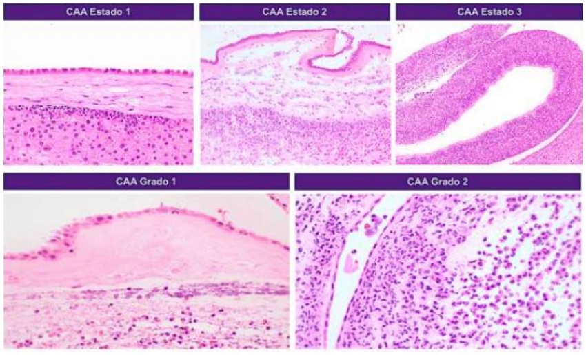 CAA estadio 1: subcorionitis aguda, con presencia de infiltrado en banda, compuesto por neutr&oacute;filos debajo de la placa cori&oacute;nica. CAA estadio 2: corioamnionitis aguda. Se observa infiltrado inflamatorio de tipo neutrof&iacute;lico en el corion y en el amnios. CAA estadio 3: corioamnionitis necrosante, donde se identifica un compromiso completo del corion y del amnios, incluyendo necrosis del amnios. Grado 1: sin formaci&oacute;n de conglomerados de c&eacute;lulas inflamatorias agudas de tipo polimorfo-nuclear neutr&oacute;filo. Grado 2: presencia de abscesos.