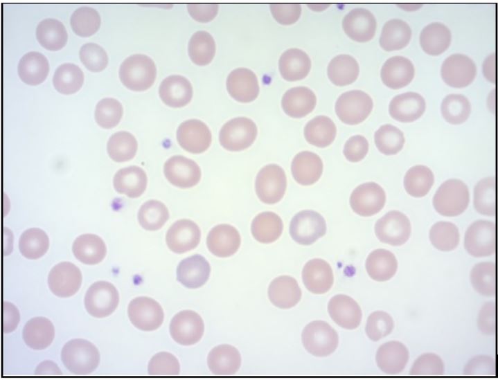 Frotis de sangre perif&eacute;rica a 100X y con tinci&oacute;n de Wright
