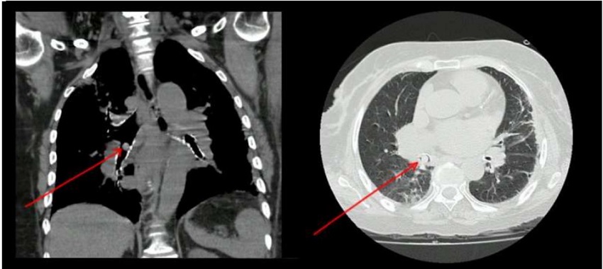 Lesión polipoide, ligeramente hiperdensa en el bronquio intermediario con dimensiones de 8 × 9 mm, y reducción de la luz en un 90%