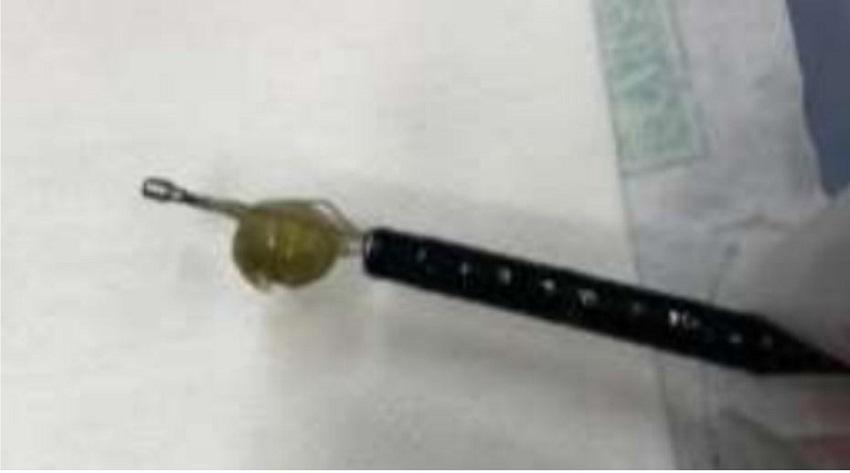 Cuerpo extraño (arveja)