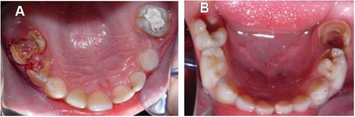 Registro fotográfico del ingreso del paciente a la clínica
para su atención. A) Maxilar superior. B) Maxilar inferior