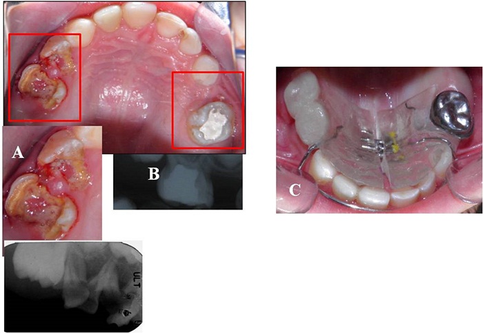 Rehabilitación del sector posterior del maxilar superior.
A) Exodoncia de los molares primer y segundo primario superior derecho. B) Tratamiento
pulpar en el segundo molar superior izquierdo. C) Corona de acero en el segundo
molar superior izquierdo e instalación del mantenedor de espacio superior removible