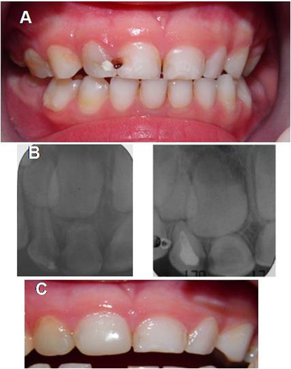 Rehabilitación del sector anterior del maxilar superior.
A) Registro fotográfico del ingreso del paciente a la clínica. B) Examen radiográfico
antes del tratamiento pulpar del incisivo lateral superior derecho y después de
esta. C) Restauración con coronas de acetato y resina