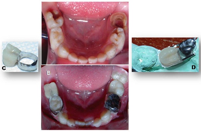Representación fotográfica de la confección y cementado
de los mantenedores de espacio tipo zapato distal propioceptivo. A y B) Fotografías
previa y posterior a la colocación del mantenedor (obsérvese la contigüidad de la
cara distal del fantoche izquierdo con el primer molar permanente parcialmente erupcionado. C y D) Confección de los dos mantenedores