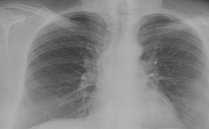 Radiograf&iacute;a de t&oacute;rax*