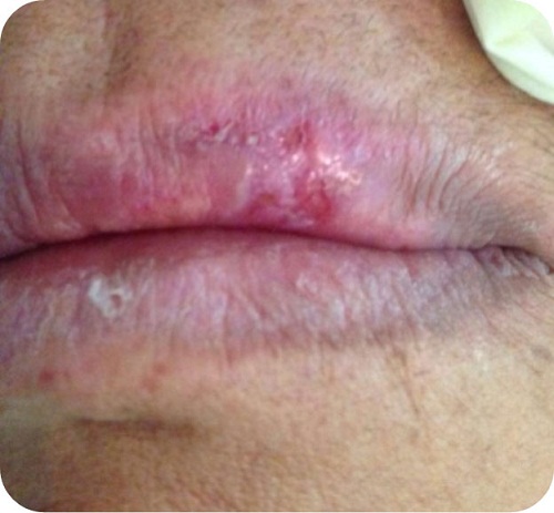 Lesi&oacute;n
asintom&aacute;tica localizada en labio superior del lado izquierdo