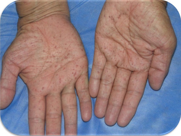 Fisuras palmoplantares