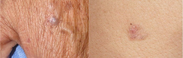 Carcinoma
basocelular en el dorso de la mano izquierda (lesi&oacute;n nodular, hiperpigmentada de
aspecto azulado) y en la espalda (lesi&oacute;n tipo placa, hiperpigmentada de aspecto
marr&oacute;n)