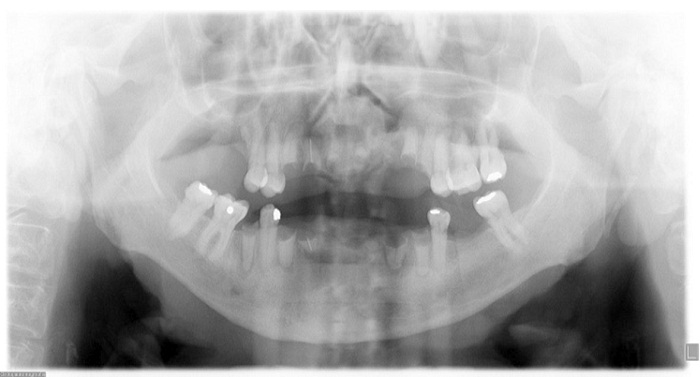 Radiograf&iacute;a
panor&aacute;mica