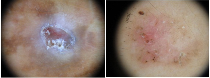 Dermatoscopias
CBC en dorso de mano izquierda y espalda