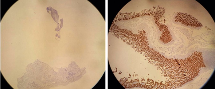 Marcadores
inmunohistoqu&iacute;micos EMA y Ber-EP4* 