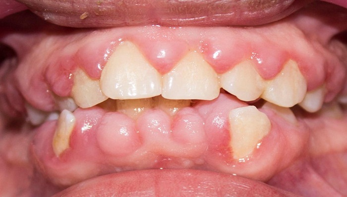 Agrandamiento gingival y acumulaci&oacute;n de placa bacteriana