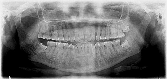 Radiograf&iacute;a panor&aacute;mica de la paciente