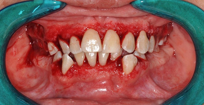 Aspecto cl&iacute;nico inmediatamente despu&eacute;s de la cirug&iacute;a