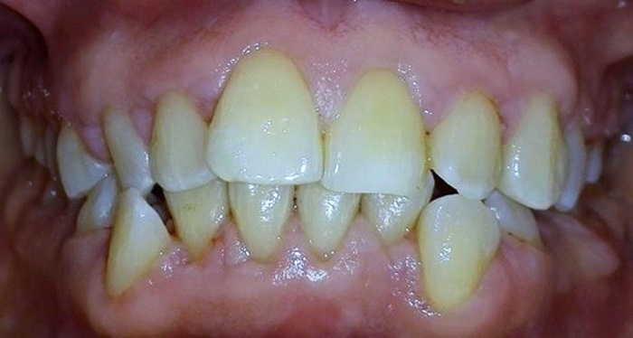 Aspecto periodontal dos meses despu&eacute;s de la cirug&iacute;a