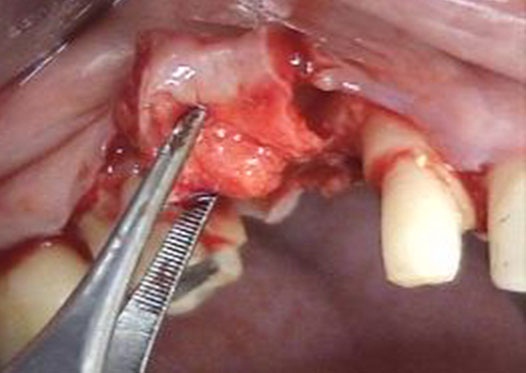 T&eacute;cnica de
rollo sin incisiones relajantes