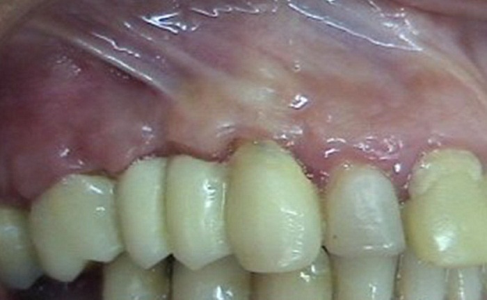 Control
cl&iacute;nico posquir&uacute;rgico a las 4 semanas 