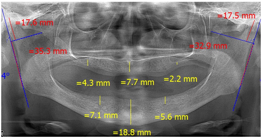 Puntos de medici&oacute;n de las alturas de los rebordes superior e inferior y alturas de rama y c&oacute;ndilo en radiograf&iacute;as de ed&eacute;ntulos totales