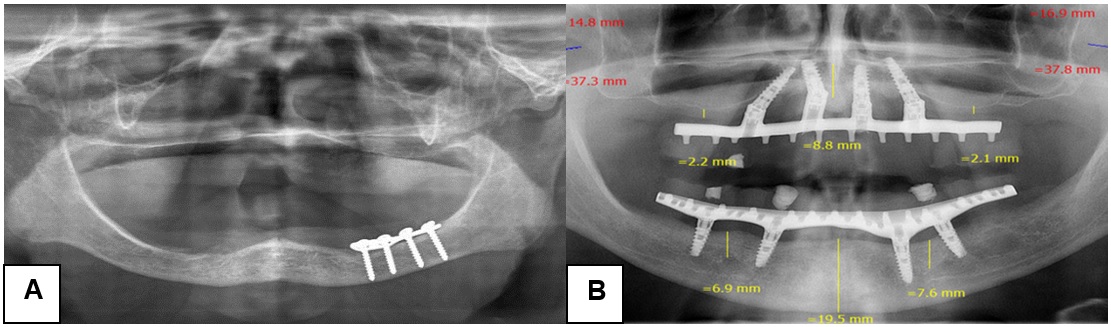 Hallazgos radiogr&aacute;ficos en los maxilares de pacientes con edentulismo total