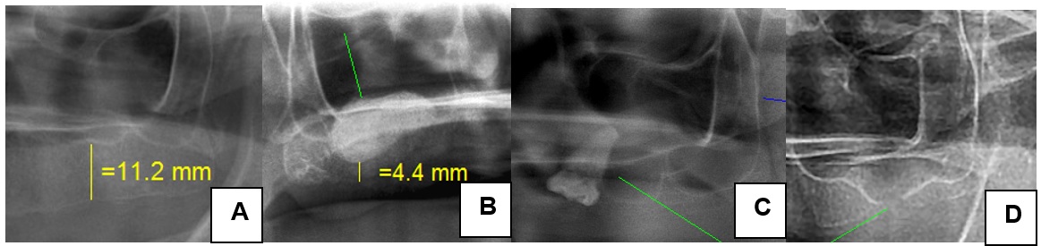 Im&aacute;genes de hallazgos radiogr&aacute;ficos en los senos maxilares