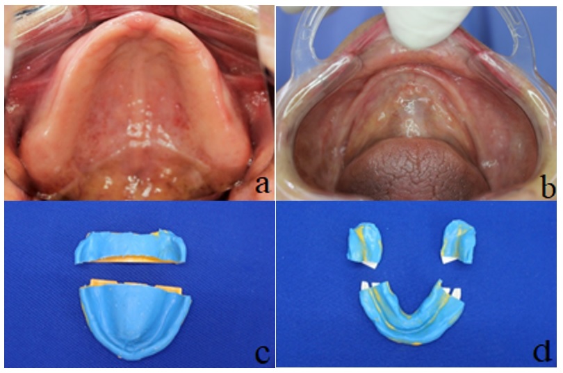 a) Base prot&eacute;sica superior. b) Base prot&eacute;sica inferior. c) Recorte extensi&oacute;n distal superior. d) Recorte extensi&oacute;n distal inferior