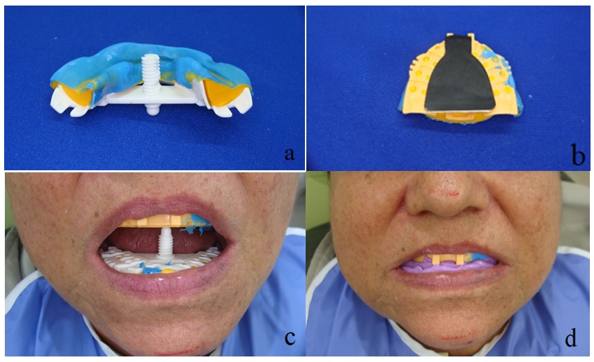 a) Ubicaci&oacute;n de la aguja inscriptora. b) Platina de inscripci&oacute;n. c) Registro de c&eacute;ntrica. d) Fijaci&oacute;n del registro intraoral