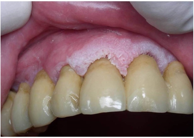 Leucoplasia verrugosa en enc&iacute;a marginal y adherida, zona anterosuperor