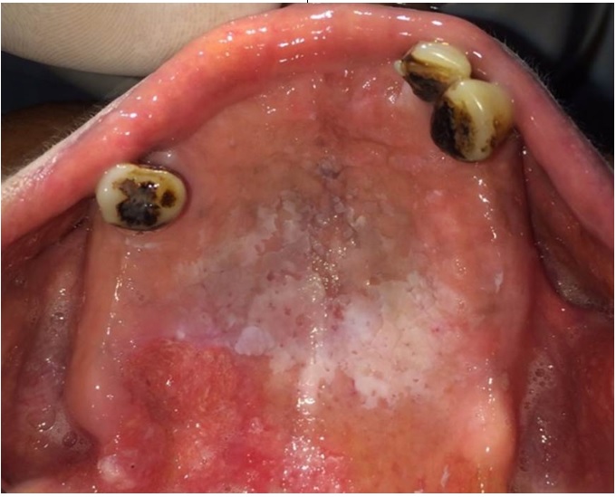 Palatitis nicot&iacute;nica que afecta toda la extensi&oacute;n del paladar duro, con carcinoma escamocelular en paciente con tabaquismo invertido