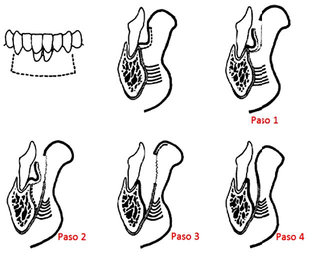 Descripci&oacute;n gr&aacute;fica de la t&eacute;cnica de vestibuloplastia seg&uacute;n Edlan Mejchar