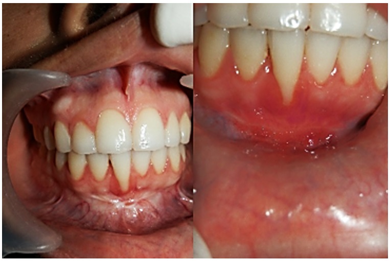 Caso 1. Aspecto periodontal antes (imagen izquierda) y 15 d&iacute;as despu&eacute;s del procedimiento (imagen derecha)