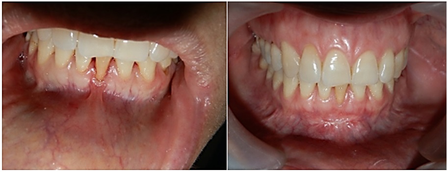Caso 2. Aspecto periodontal (imagen izquierda) con sobreinserci&oacute;n del frenillo antes y 15 d&iacute;as despu&eacute;s del procedimiento (imagen derecha)