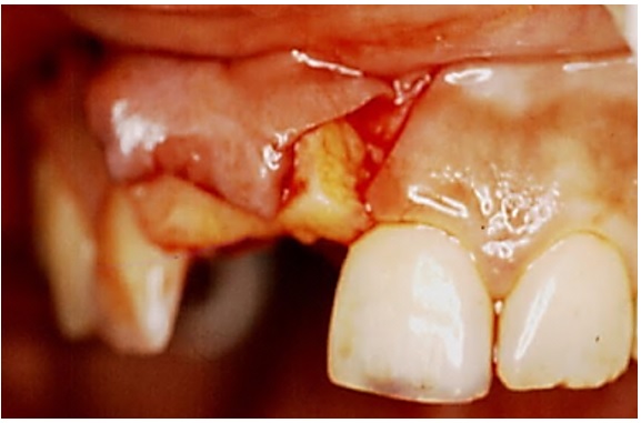 Injerto de tejido conectivo dentro del sitio receptor