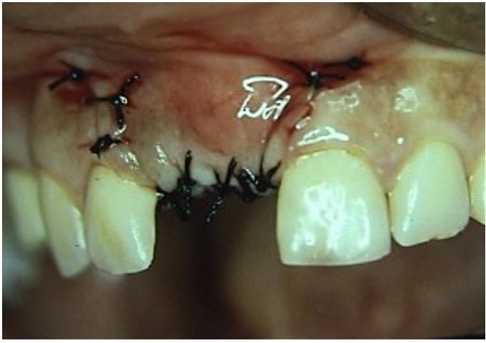 Injerto de tejido conectivo cubierto por el colgajo el cual se desplaz&oacute; coronalmente