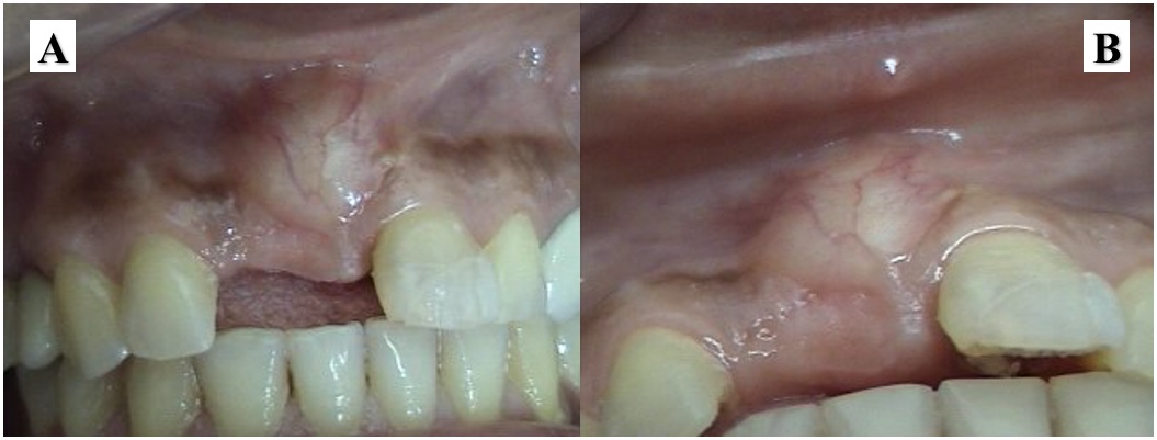 &Aacute;rea de exostosis 7 a&ntilde;os despu&eacute;s de la cirug&iacute;a
