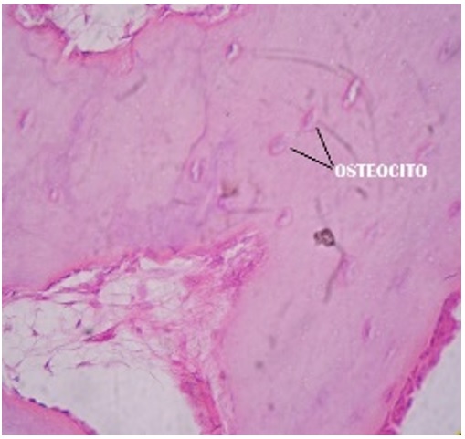 Corte histol&oacute;gico de la biopsia de la exostosis