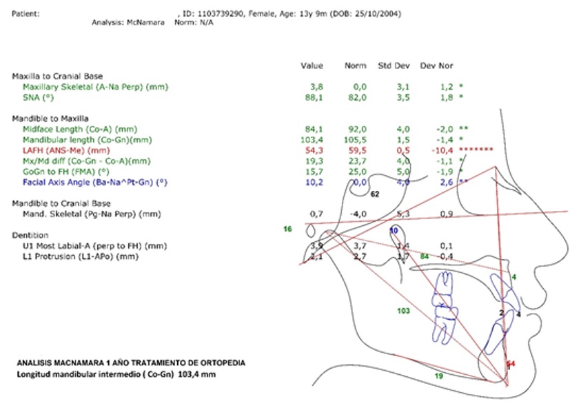 Cefalometr&iacute;a de McNamara despu&eacute;s de un a&ntilde;o