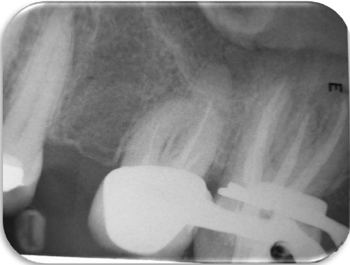 PRUEBA DE OBTURACI&Oacute;N