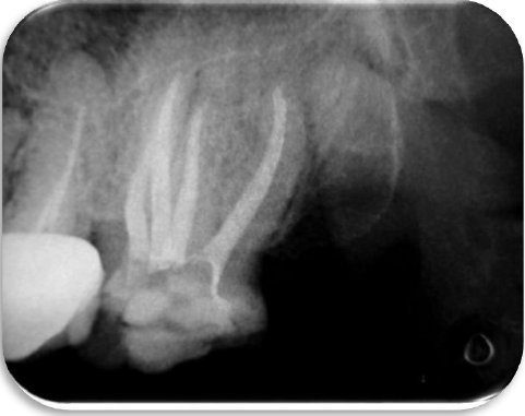 RADIOGRAF&Iacute;A DE FINAL O DE OBTURACI&Oacute;N