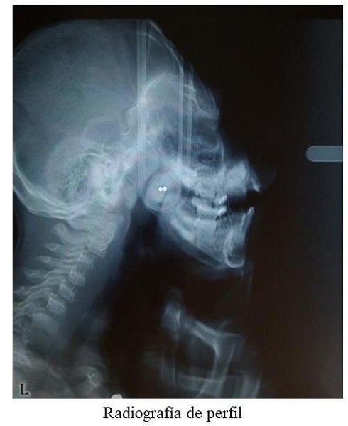 RADIOGRAF&Iacute;A DE PERFIL