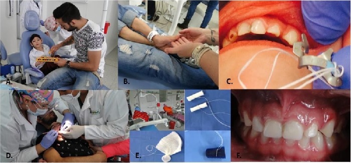 FOTOS DURANTE Y AL FINAL DEL TRATAMIENTO A Y B ADAPTACI&Oacute;N C LIMITACI&Oacute;N DE LA APERTURA PARA BUSCAR AISLAMIENTO ABSOLUTO D RETIRO DE CARIES E MEDIDAS DE SEGURIDAD EN LA ATENCI&Oacute;N F TRATAMIENTO TERMINADO