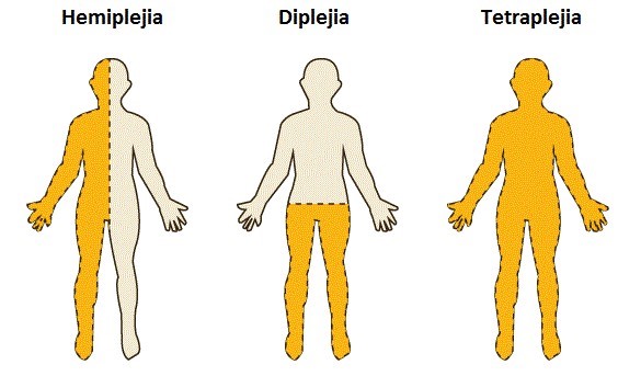 TIPOS DE PAR&Aacute;LISIS CEREBRAL SEG&Uacute;N LAS &Aacute;REAS DEL CUERPO AFECTADAS. COPYRIGHT 2019 POR EFISIOPEDIATRIC. AFECTADAS. 2016 [CITED 11 OCTOBER 2019]. AVAILABLE FROM: HTTPS://EFISIOPEDIATRIC.INFO/WP-CONTENT/UPLOADS/2016/10/CUADRO-TIPOS.JPG