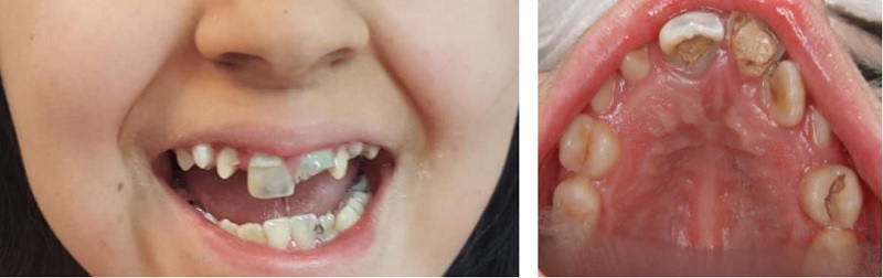 RESULTADO POST TRATAMIENTO BAJO SEDACI&Oacute;N ENDOVENOSA