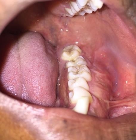 LESI&Oacute;N TUMORAL EN ZONA POSTEROINFERIOR IZQUIERDA QUE COMPROMETE &Oacute;RGANOS DENTALES